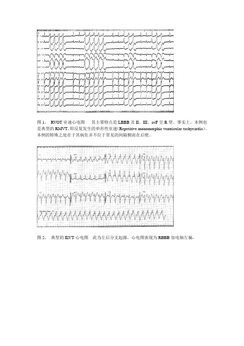 室性心动过速心电图