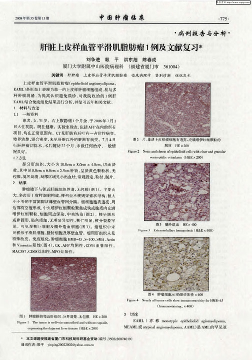 肝脏上皮样血管平滑肌脂肪瘤1例及文献复习