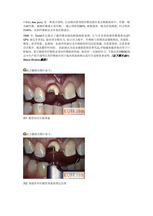 纤维桩的选择和临床应用