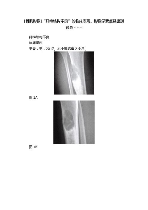 [骨肌影像]“纤维结构不良”的临床表现、影像学要点及鉴别诊断~~~