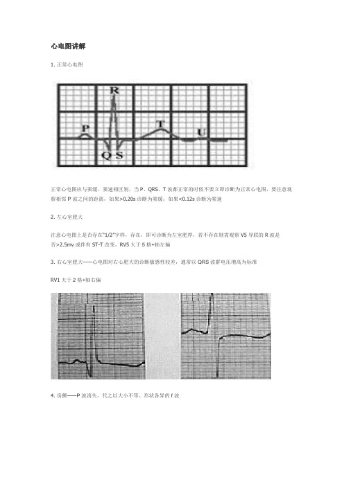 心电图讲解