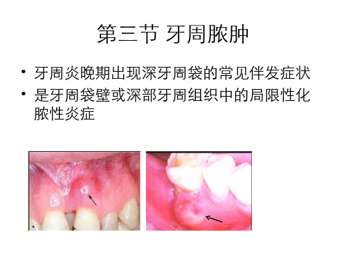 牙周脓肿