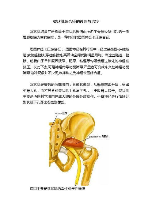 梨状肌综合征的诊断与治疗