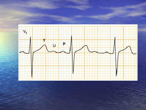 中国区国际心电图培训课程之典型病例
