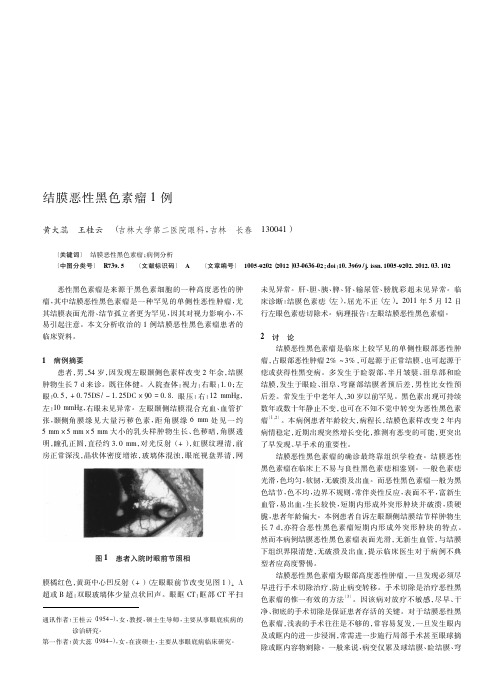 结膜恶性黑色素瘤1例