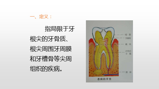 第五章  慢性根尖周炎