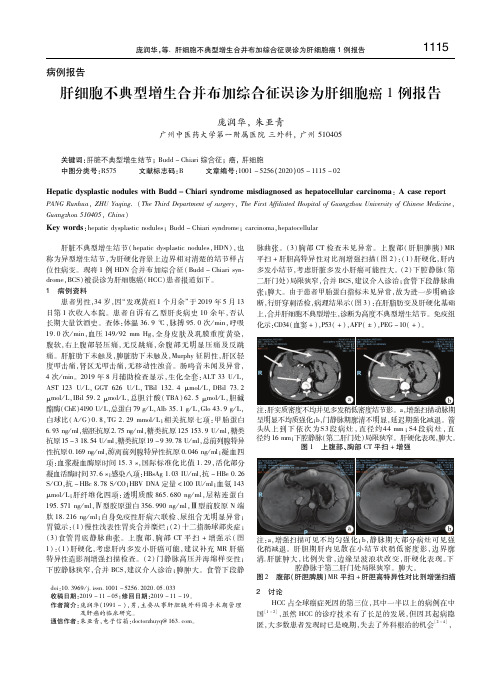 肝细胞不典型增生合并布加综合征误诊为肝细胞癌1例报告 庞润华