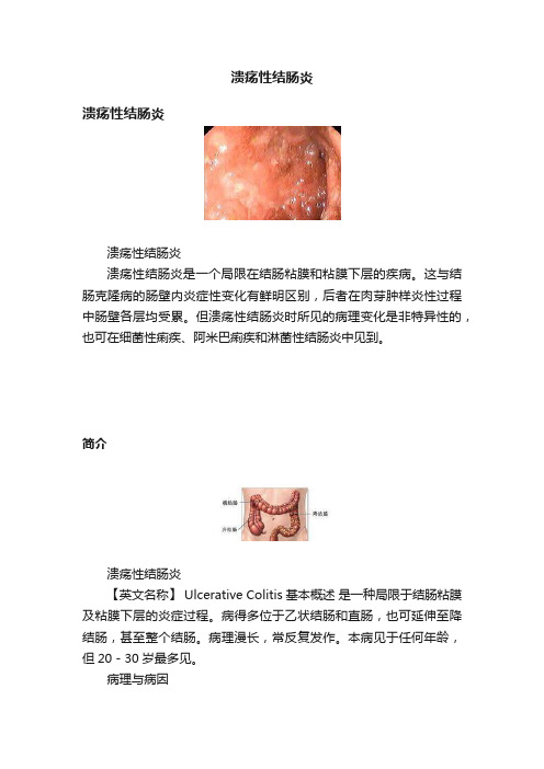 溃疡性结肠炎