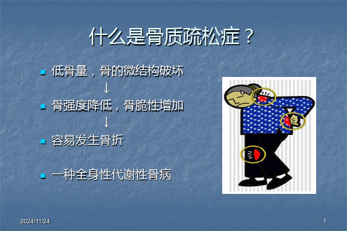 骨质疏松症讲ppt课件(1).ppt