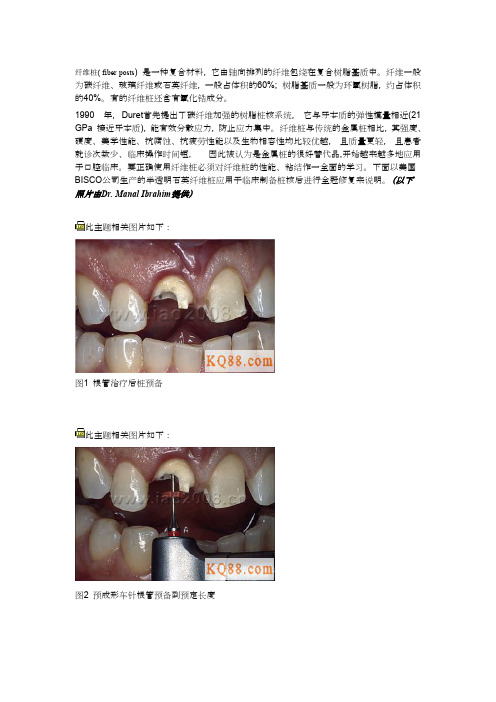 纤维桩的选择和临床应用