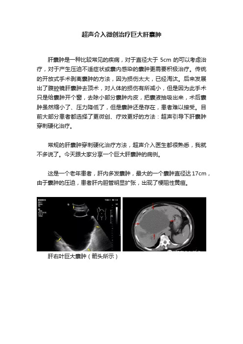 超声介入微创治疗巨大肝囊肿