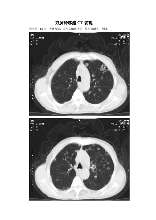 双肺转移瘤CT表现