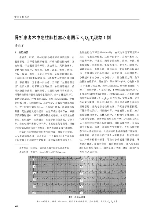 骨折患者术中急性肺栓塞心电图示sⅠqⅢtⅢ现象1例