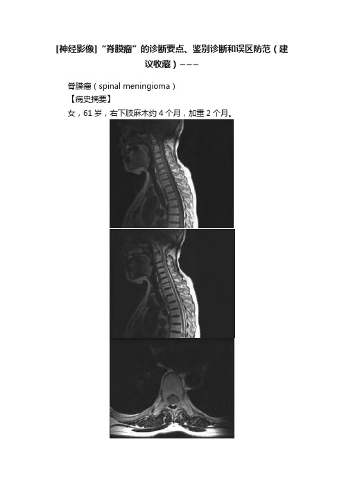 [神经影像]“脊膜瘤”的诊断要点、鉴别诊断和误区防范（建议收藏）~~~