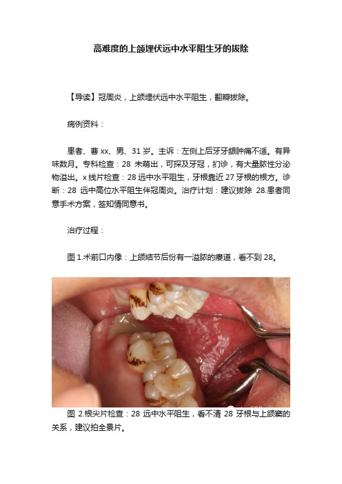 高难度的上颌埋伏远中水平阻生牙的拔除