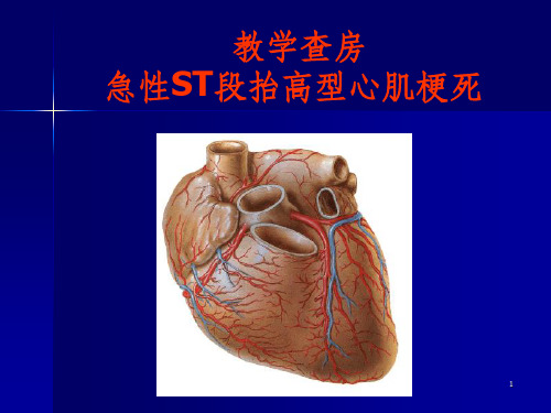 教学查房(急性心肌梗死)