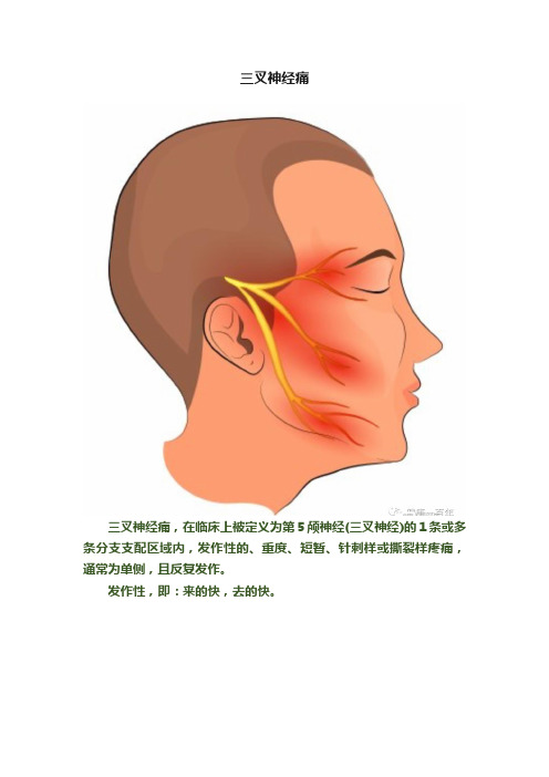 三叉神经痛