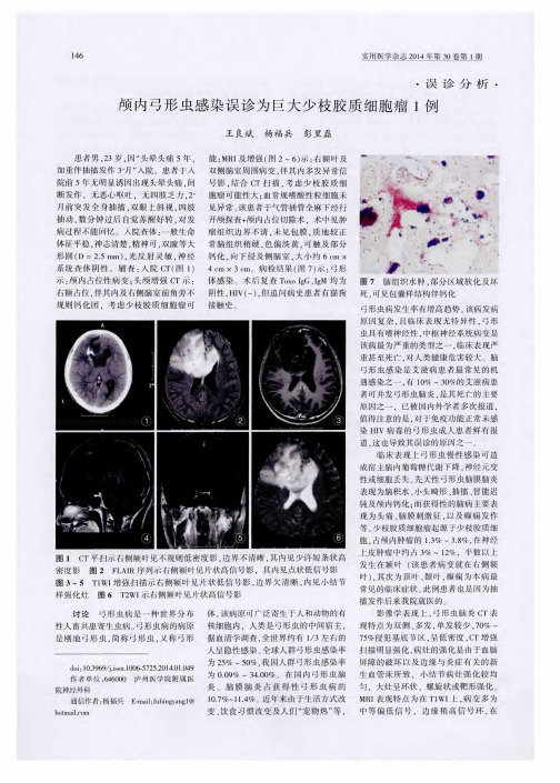 颅内弓形虫感染误诊为巨大少枝胶质细胞瘤1例