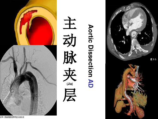 主动脉夹层临床表现及治疗借鉴ppt