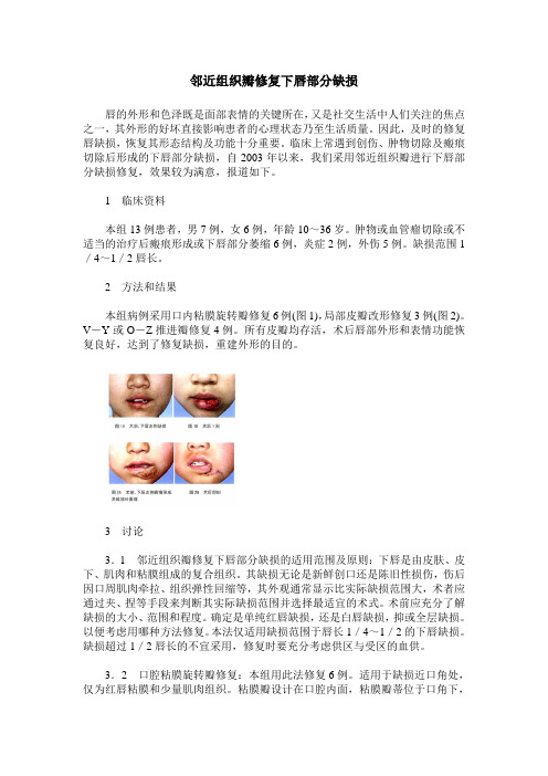 邻近组织瓣修复下唇部分缺损