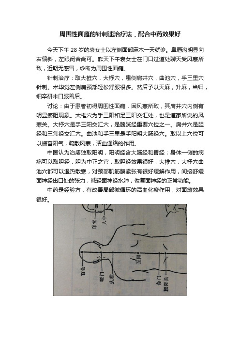 周围性面瘫的针刺速治疗法，配合中药效果好