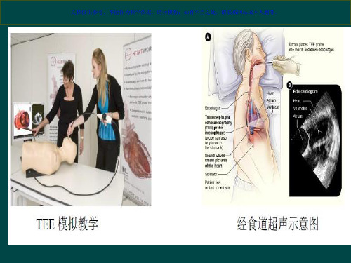 经食道超声临床应用课件