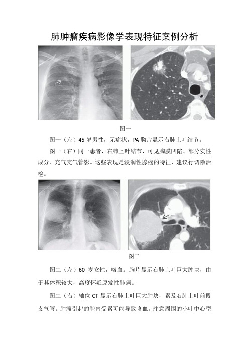 肺肿瘤疾病影像学表现特征案例分析