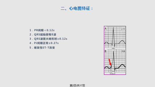 预激综合征教程.pptx