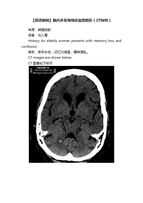 【双语病例】脑内多发海绵状血管畸形（CTMRI）