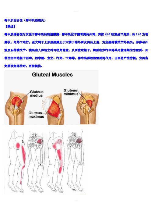 臀中肌综合征(臀中肌筋膜炎)