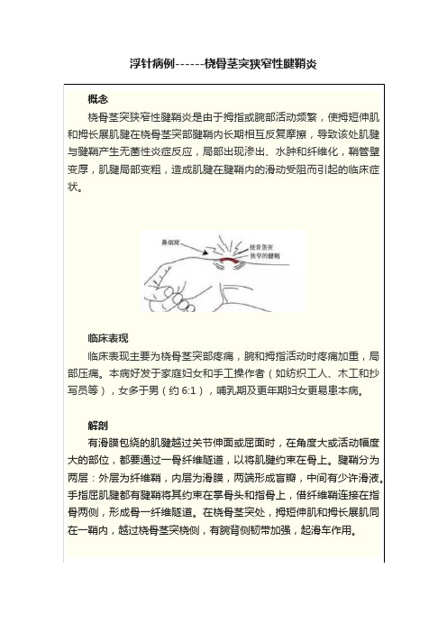 浮针病例------桡骨茎突狭窄性腱鞘炎