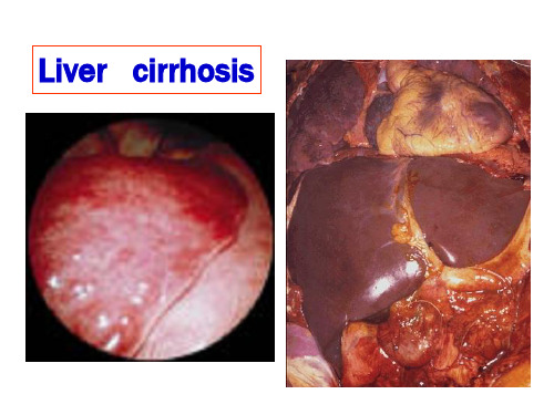病理学课件4.肝硬化