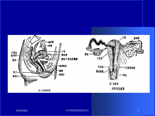 妇科肿瘤的放射治疗课件