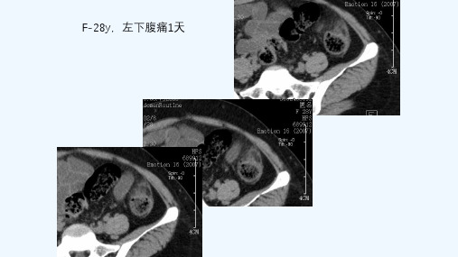 腹腔炎性脂肪性肿块的鉴别诊断ppt课件