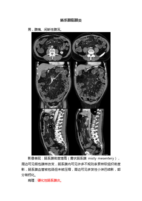 肠系膜脂膜炎