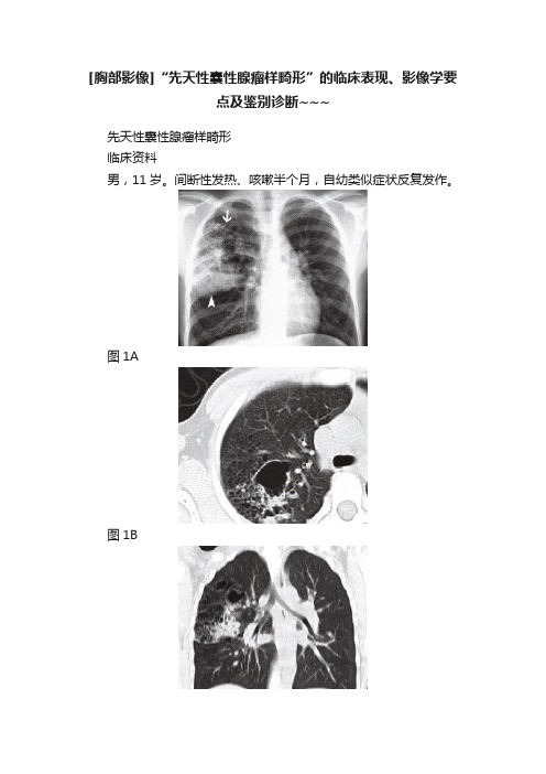 [胸部影像]“先天性囊性腺瘤样畸形”的临床表现、影像学要点及鉴别诊断~~~