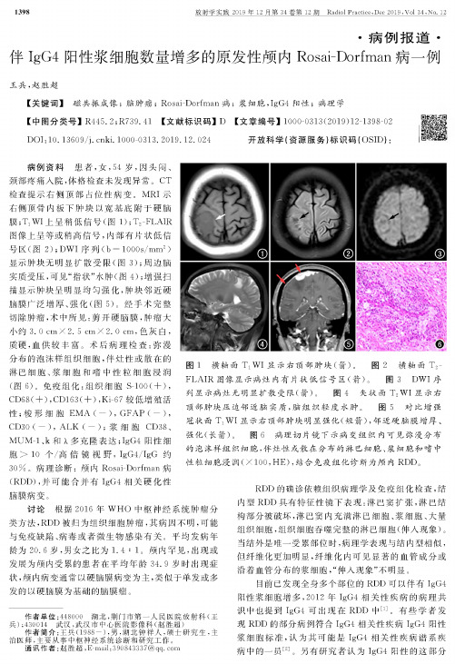 伴igg4阳性浆细胞数量增多的原发性颅内rosai-dorfman病一例