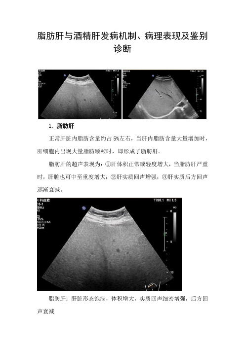 脂肪肝与酒精肝发病机制、病理表现及鉴别诊断