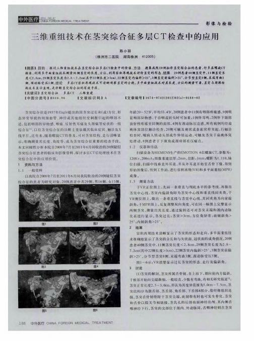 三维重组技术在茎突综合征多层CT检查中的应用