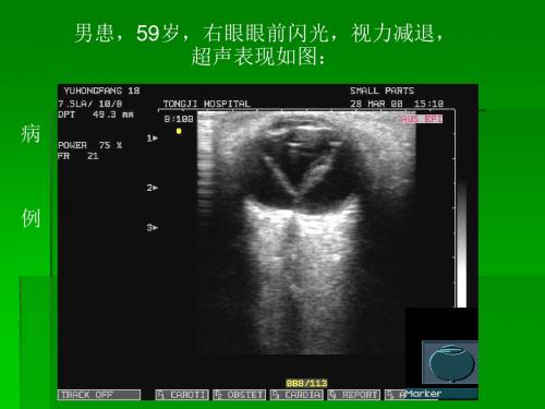 甲状腺超声诊断ppt课件