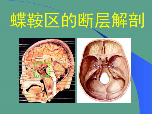 蝶鞍区的断层解剖ppt课件