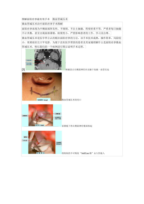 图解面肌痉挛最有效手术