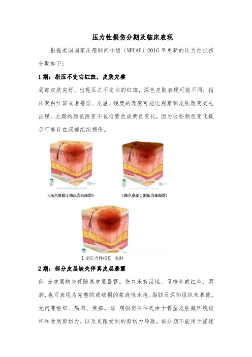 压力性损伤分期及临床表现