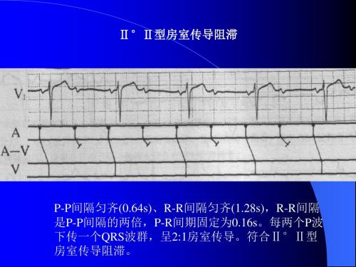 Ⅱ°Ⅱ型房室传导阻滞