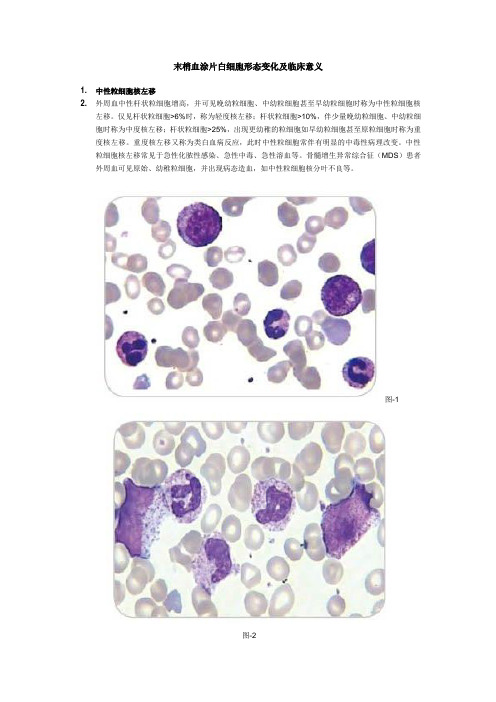 末梢血涂片白细胞形态变化及临床意义