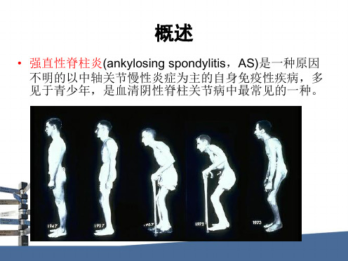 强直性脊柱炎评分