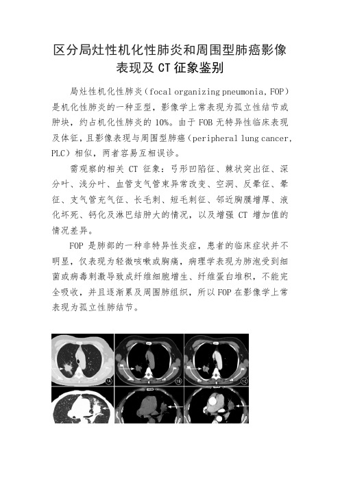 区分局灶性机化性肺炎和周围型肺癌影像表现及CT征象鉴别