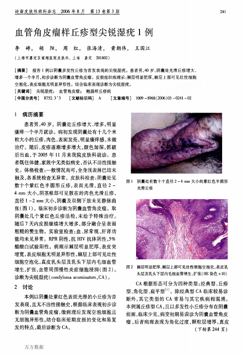 血管角皮瘤样丘疹型尖锐湿疣1例