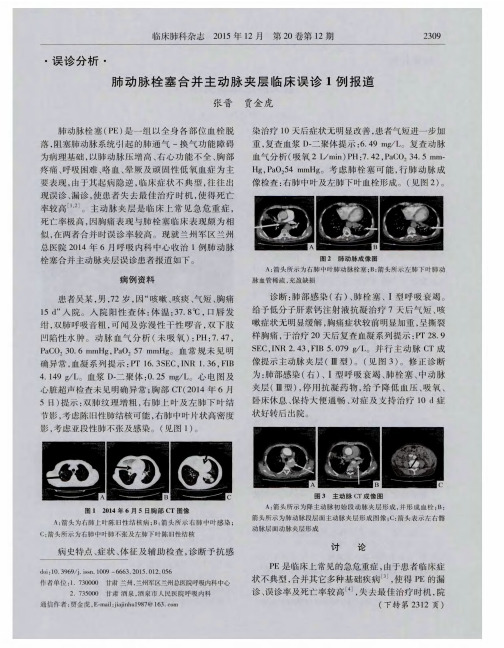 肺动脉栓塞合并主动脉夹层临床误诊1例报道