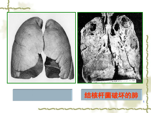 结核病防治知识PPT课件